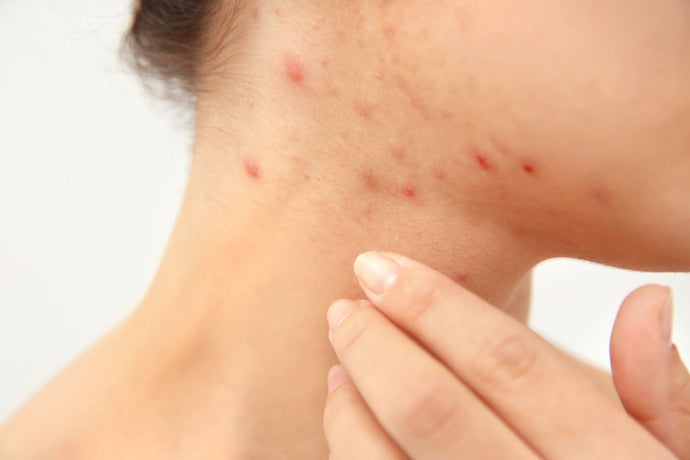 What is Acne? Understanding the Different Types and Best Practices for Clearer Skin-by Lynn Jenkins