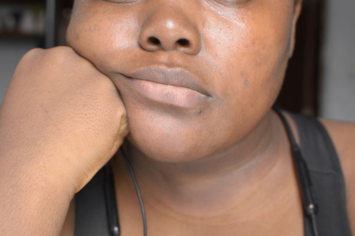 What is Hyperpigmentation? How can I diminish its appearance?-by Lynn Jenkins