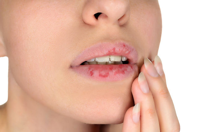Luxurious Treatments for Chronicly Dry Lips-by Lynn Jenkins
